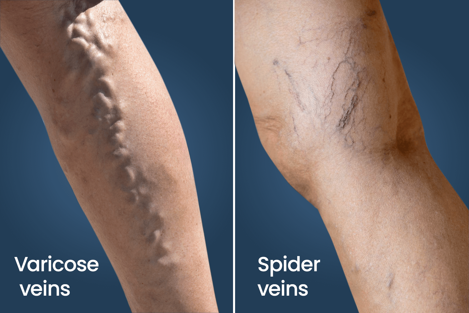 Red Or Blue Light Therapy For Spider Veins Shelly Lighting